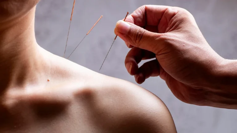 Dry needling za mišićne bolne tačke i napetost